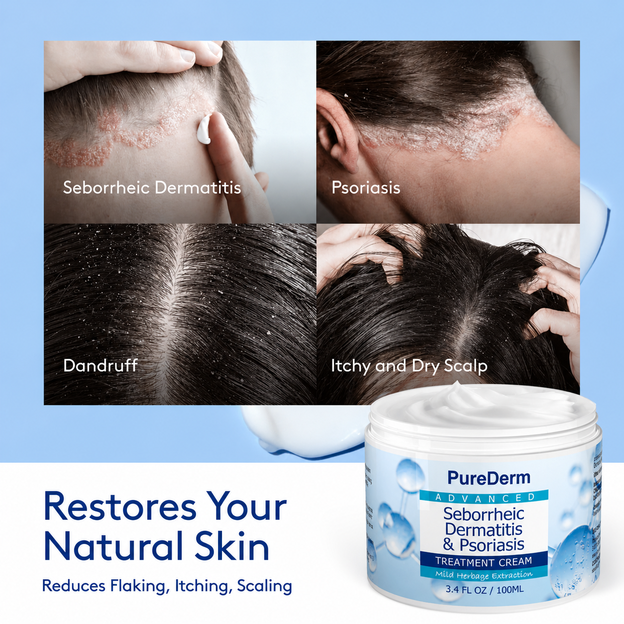 Seborrheic Dermatitis & Psoriasis Cream