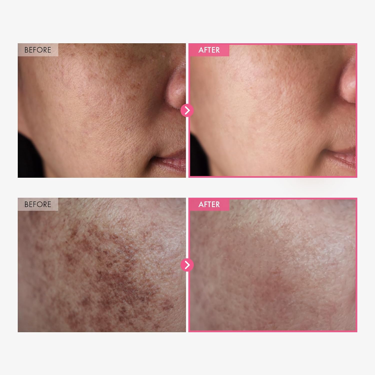 Fade Dark Spots Fast with Korean Arbutin