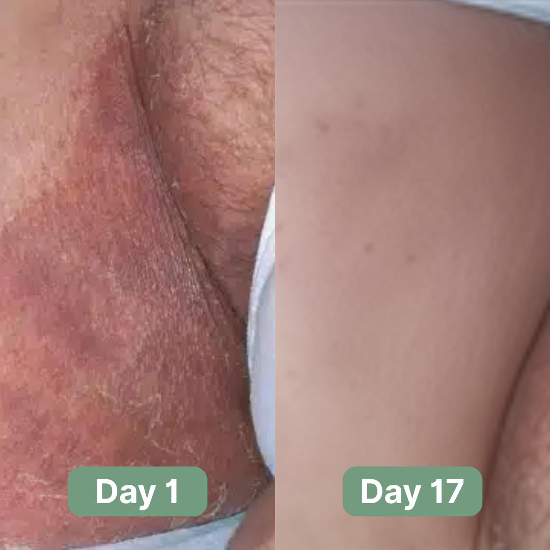 PureDerm Relief Antifungal Soap