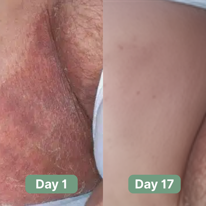 PureDerm Relief Antifungal Soap