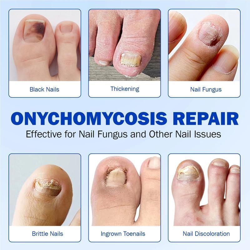 FUNGEX Fungal Nail Repair Patches