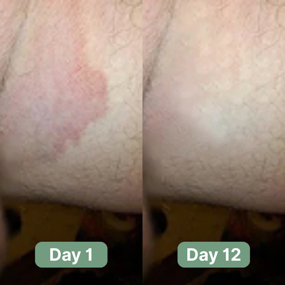 PureDerm Relief Antifungal Soap