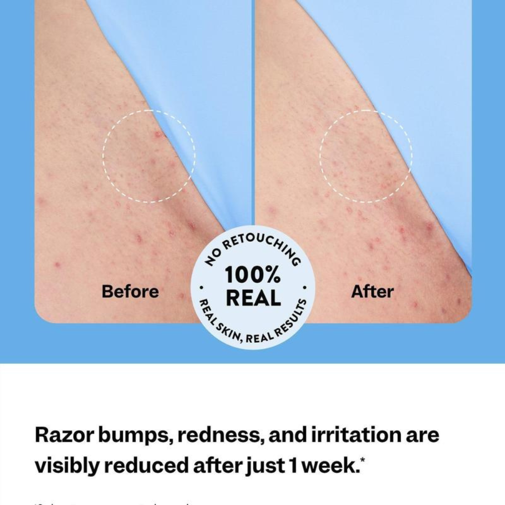 SmoothGuard Ingrown Hair Fix Roll-On