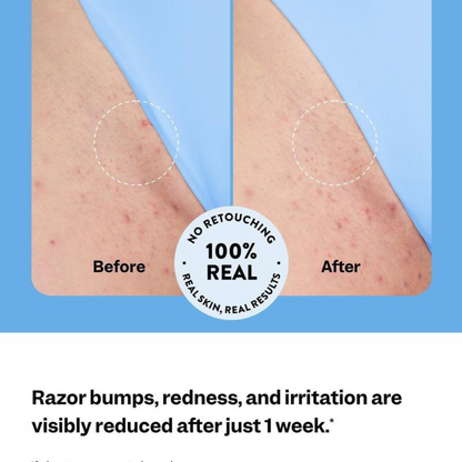 SmoothGuard Ingrown Hair Fix Roll-On
